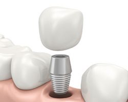 Dental Implants 1 Midlothian, VA Dentist | Biggers Family Dentistry